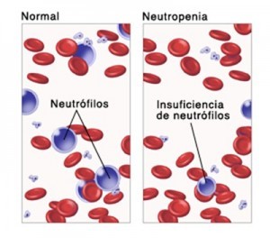 Neutrófilos bajos y sus causas