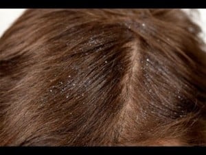 Tips para el cabello Con caspa