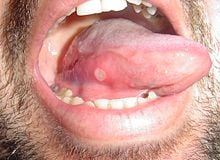 Cómo curar llagas:  en la boca En la lengua