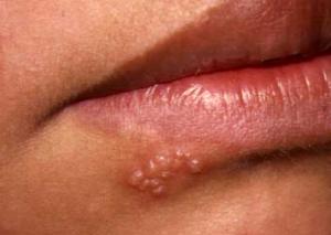 Herpes en la cara:  cómo reconocerlo